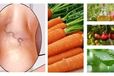 Phương thuốc “tự nhiên” giúp chữa giãn tĩnh mạch chân