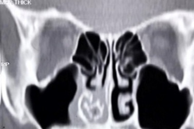 Dị vật bỏ quên khiến mũi bé trai liên tục chảy máu