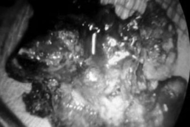 Lấy dị vật cứng như đá trong… mũi bệnh nhân