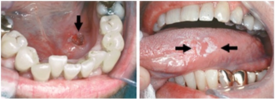 8 dấu hiệu phát hiện sớm ung thư khoang miệng - 1 8 dấu hiệu phát hiện sớm ung thư khoang miệng - 1