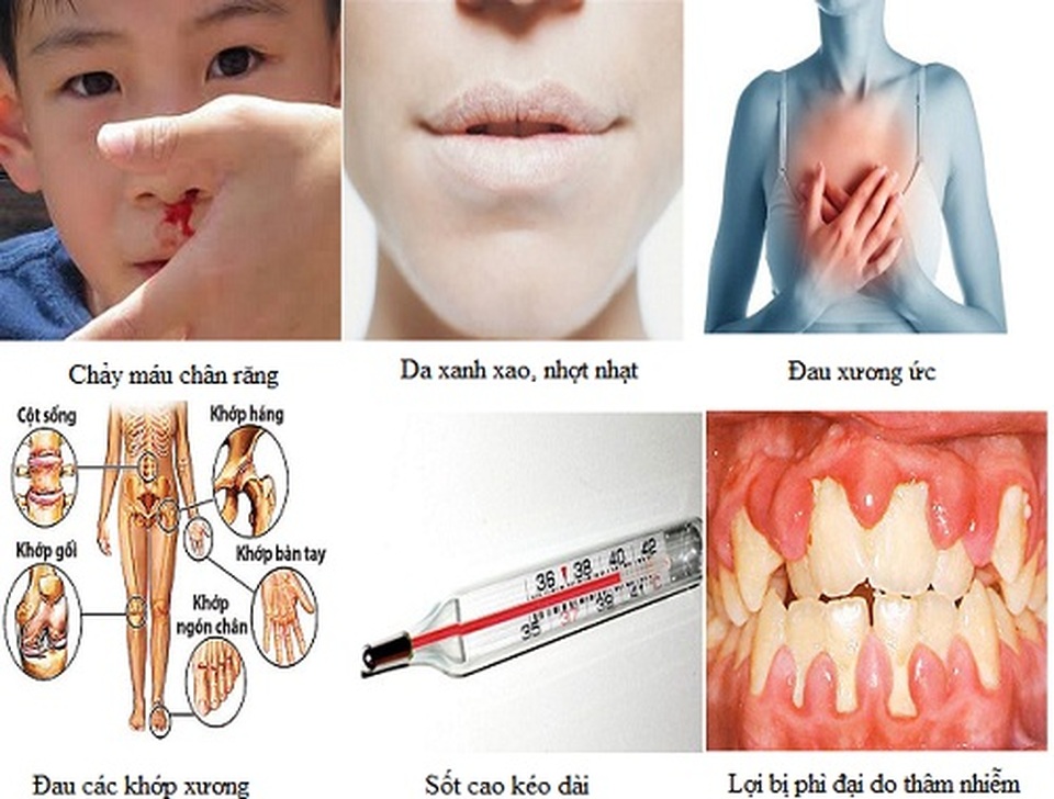 Bệnh ung thư máu cấp biểu hiện như thế nào? - 1 Bệnh ung thư máu cấp biểu hiện như thế nào? - 1