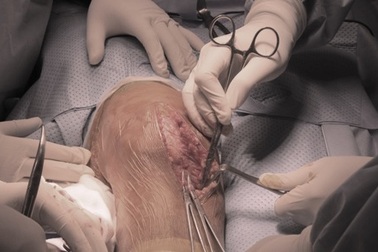 Thay khớp gối cho bệnh nhân máu khó đông bẩm sinh