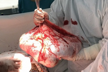 Bóc tách thành công khối u buồng trứng nặng 35kg trong bụng