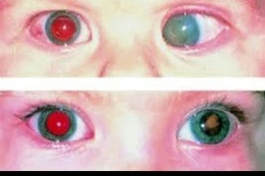 Có ánh đồng tử trắng, cần làm gì để xác định nguy cơ ung thư võng mạc?