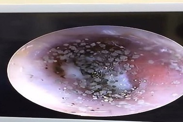 Bé 10 tuổi bị mọc nấm trong tai vì đeo tai nghe quá nhiều