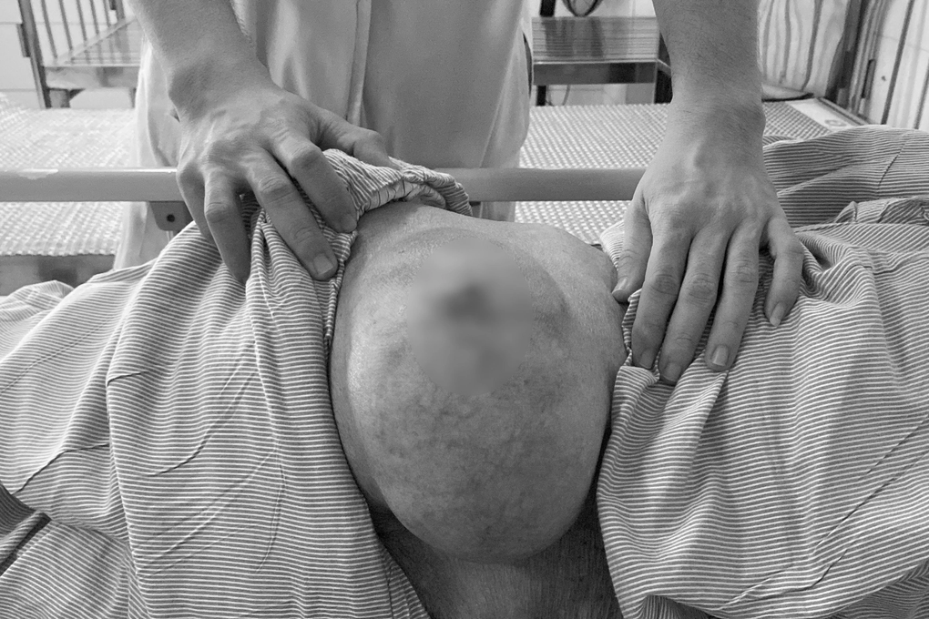 Cắt bỏ khối u vùng mông kích thước lớn cho cụ ông 97 tuổi - 1 Cắt bỏ khối u vùng mông kích thước lớn cho cụ ông 97 tuổi - 1