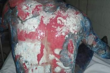 Rước họa khi tự ý sử dụng thuốc Nam