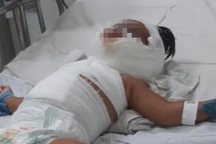 TPHCM: Bé gái 1 tuổi bỏng thương tâm vì ngã vào nồi nước sôi mẹ nấu