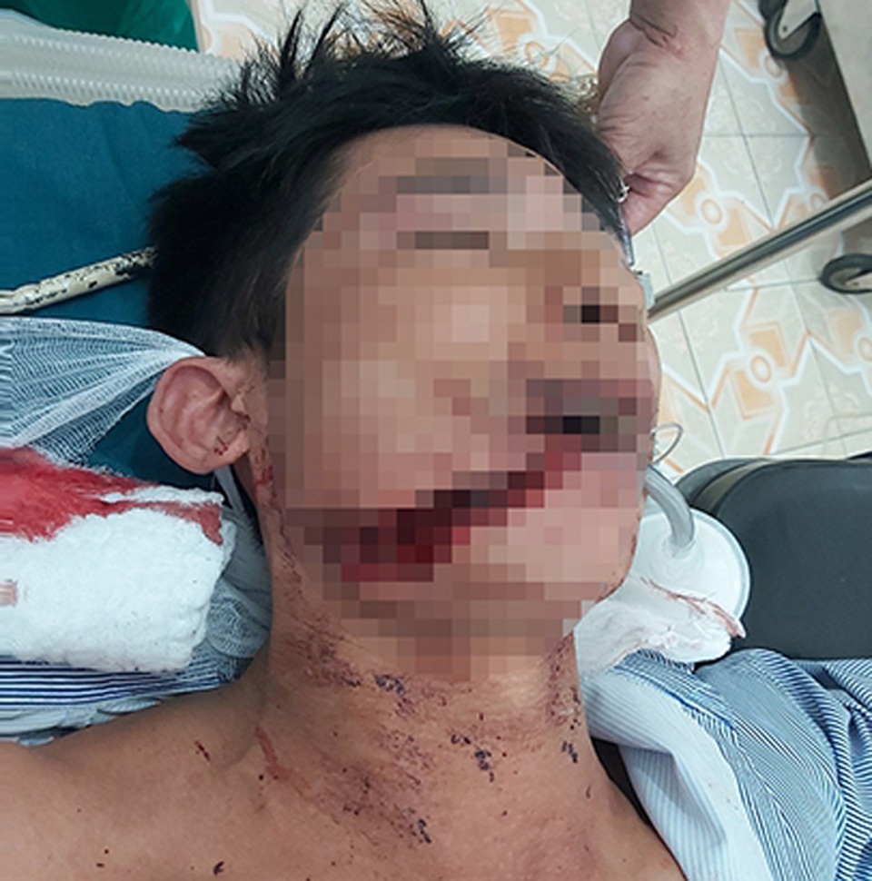 Bị trâu dữ tấn công, người đàn ông phải khâu hàng chục mũi - 1