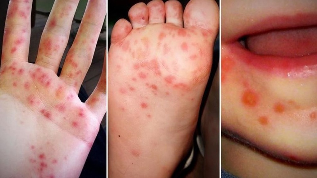 Trẻ bị tay chân miệng vừa chữa xong đã đầy giường, nhiều ca nặng - 3 Trẻ bị tay chân miệng vừa chữa xong đã đầy giường, nhiều ca nặng - 3