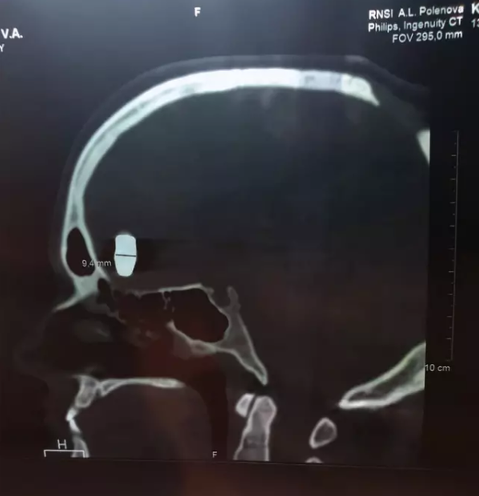 Ăn mừng 10 năm sống bình thường với một viên đạn trong não - 3 Ăn mừng 10 năm sống bình thường với một viên đạn trong não - 3