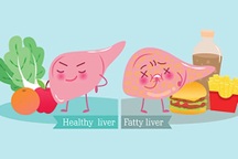 Gan nhiễm mỡ độ 2 kiêng gì và nên ăn gì?
