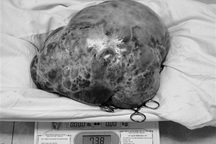 Lấy thành công khối u khủng trong bụng cụ bà 80 tuổi