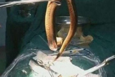 Người đàn ông lĩnh hậu quả vì nuốt lươn sống dài 30cm vào bụng