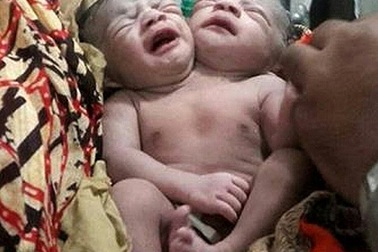 Hiếm gặp bé sơ sinh hai đầu vừa chào đời