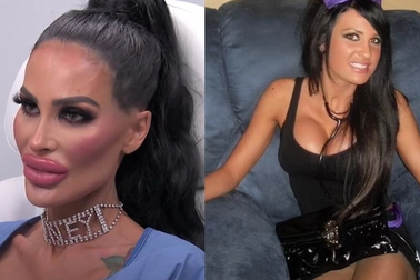 Lạm dụng "dao kéo" thẩm mỹ, gương mặt người mẫu Australia bị biến dạng