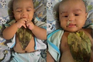 Bé gái bỏng ngực nặng vì... trị sổ mũi bằng lá trầu