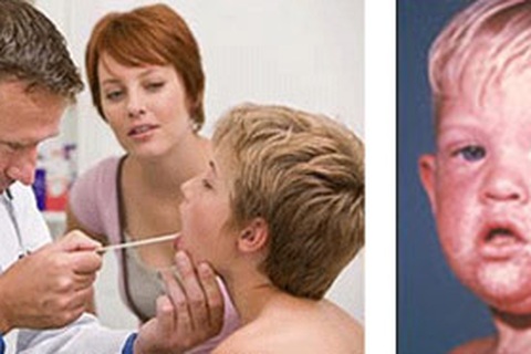 Hoa Kỳ: Cảnh báo người dân không nên chủ quan với sởi!