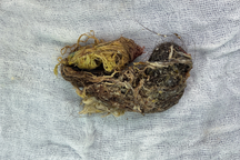 Bé gái 5 tuổi mắc hội chứng hiếm gặp: Thích ăn tóc