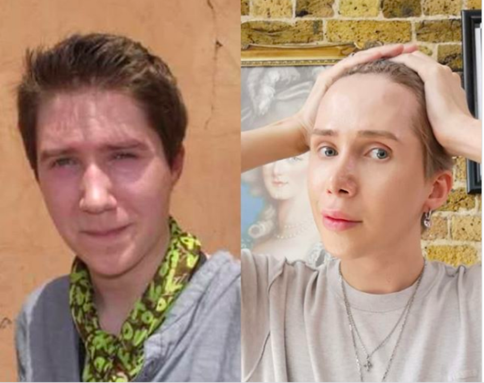 Chi 3,5 tỉ đồng để phẫu thuật từ da trắng tóc vàng thành thần tượng K-pop - 2 Chi 3,5 tỉ đồng để phẫu thuật từ da trắng tóc vàng thành thần tượng K-pop - 2