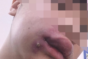 Chàng trai nhiễm khuẩn huyết vì... nặn mụn