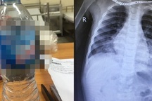 Trẻ bị viêm phổi, xuất huyết tiêu hóa vì uống nhầm chất tẩy trắng giày dép