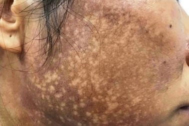 Da mặt như “bánh đa vừng đen” vì bôi kem trộn làm trắng