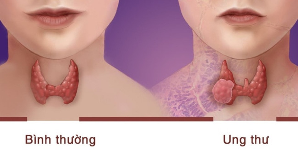 Loại bệnh ung thư phụ nữ dễ mắc hơn nam giới - 1 Loại bệnh ung thư phụ nữ dễ mắc hơn nam giới - 1