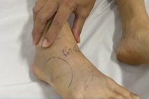 Bị rắn lục đuôi đỏ tấn công, bé trai 4 tuổi nhiễm độc nặng