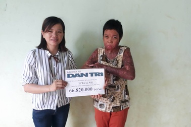 Thiếu phụ Ê Đê bị bỏng nặng sẽ được ghép da và ở trong nhà mới