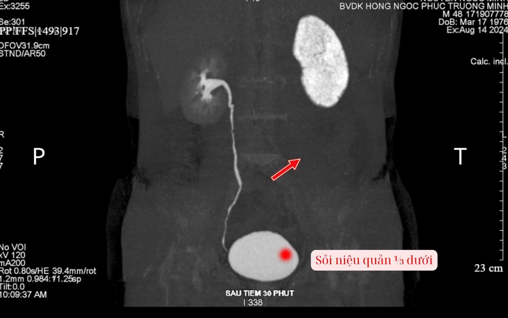 Cơn đau quặn thận - Đâu là thời điểm vàng để can thiệp? - 2 Cơn đau quặn thận - Đâu là thời điểm vàng để can thiệp? - 2
