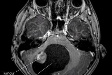 Bé 9 tuổi có u não to bằng…quả cam