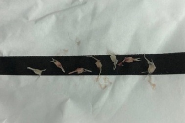 Người nhà sơ ý, 7 đốt xương cá sặc vào phổi bé gái