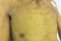 Vàng da, vàng mắt vì sỏi đường mật, tắc mật