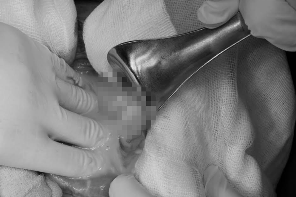 Tự mua thuốc uống trị đau bụng, người đàn ông nguy kịch vì thủng ruột - 2 Tự mua thuốc uống trị đau bụng, người đàn ông nguy kịch vì thủng ruột - 2