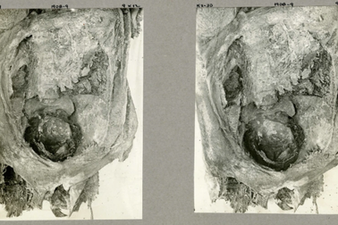 Phát hiện xác ướp thiếu nữ Ai Cập cổ đại chết khi sinh song thai
