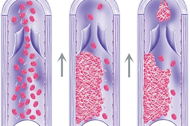 Huyết khối tĩnh mạch- "kẻ sát nhân" thầm lặng trong mổ đẻ