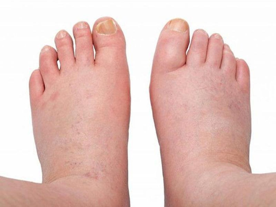 Tại sao người bị suy thận độ 2 nên sử dụng Ích Thận Vương? - 2 Tại sao người bị suy thận độ 2 nên sử dụng Ích Thận Vương? - 2