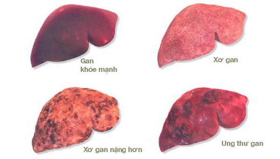 Lý do khiến chàng trai 20 tuổi đã mắc ung thư gan - 2 Lý do khiến chàng trai 20 tuổi đã mắc ung thư gan - 2