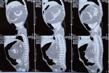 Bé trai chào đời mang theo người em song sinh… trong bụng