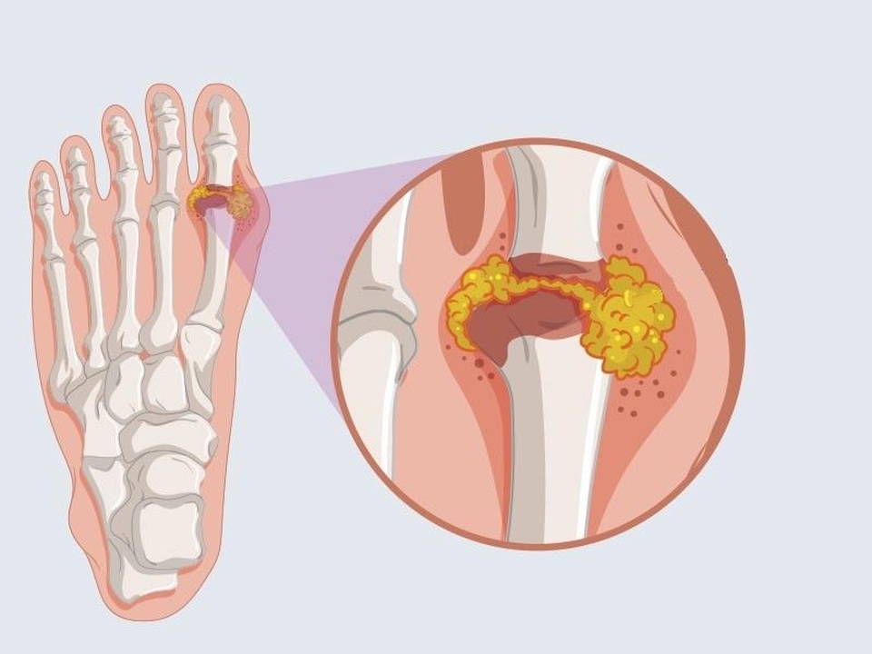 Sản phẩm Hoàng Thống Phong – Giải pháp hữu hiệu cho người bị gút ở ngón chân - 1 Sản phẩm Hoàng Thống Phong – Giải pháp hữu hiệu cho người bị gút ở ngón chân - 1