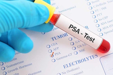 Chỉ số PSA và những cảnh báo nguy cơ ung thư tiền liệt tuyến
