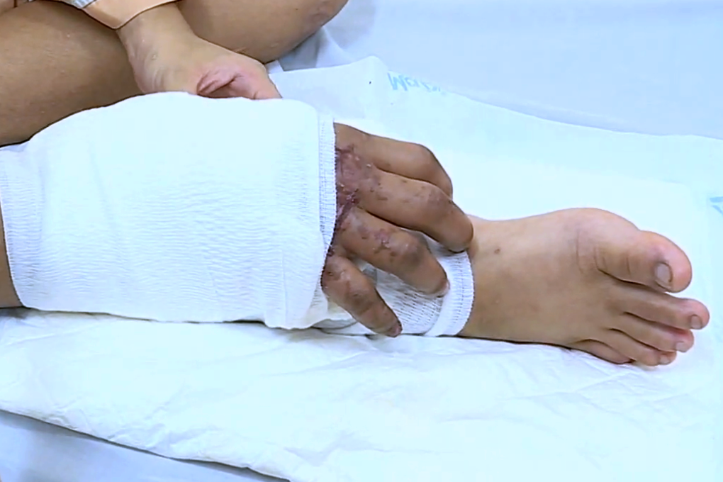 Thông tin mới nhất về cô gái mang thai được ghép tạm tay đứt lìa vào chân - 2 Thông tin mới nhất về cô gái mang thai được ghép tạm tay đứt lìa vào chân - 2