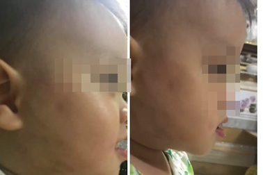 Hà Nội: Phụ huynh “tố” bé 20 tháng bị cô giáo đánh bầm tím ở lớp