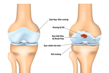 Bệnh viêm khớp gối: Nguyên nhân và cách điều trị hiệu quả