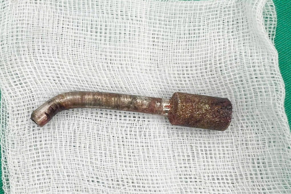 Mũi khoan dài gần 8cm đâm xuyên hốc mũi nam công nhân - 1 Mũi khoan dài gần 8cm đâm xuyên hốc mũi nam công nhân - 1