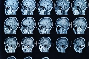 Nên dừng thai nghén nếu xác định hội chứng đầu nhỏ do vi rút Zika