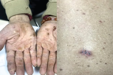 Nhiễm độc thạch tín gây ung thư da từ mỹ phẩm không rõ nguồn gốc