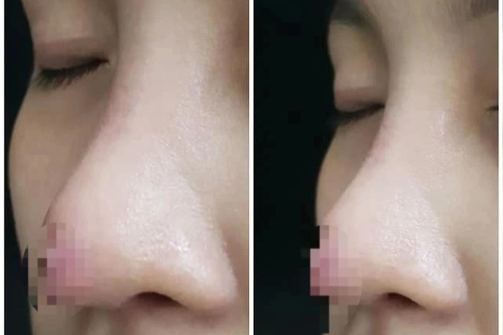 Chuyên gia thẩm mỹ: Người Việt không nên làm mũi lai Tây, chuẩn Hàn - 1 Chuyên gia thẩm mỹ: Người Việt không nên làm mũi lai Tây, chuẩn Hàn - 1