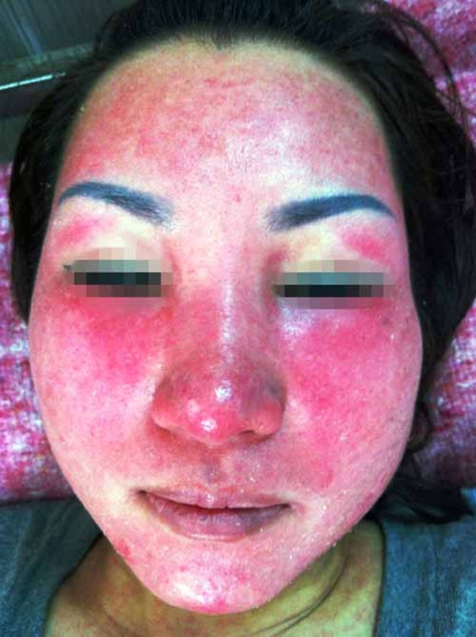 Khuôn mặt dị dạng vì dùng kem tẩy trắng siêu tốc.